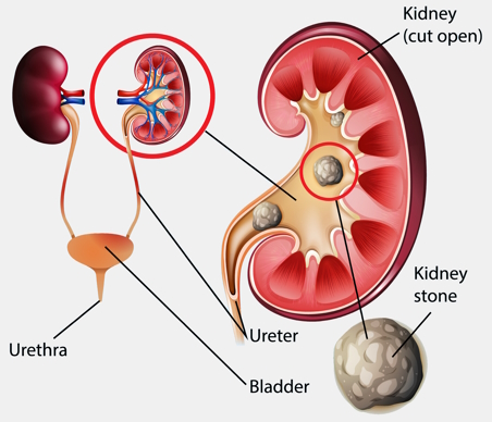 Kidney stone Anatomic illustration of a kidney stone within a cutaway view of the kidney and ureter